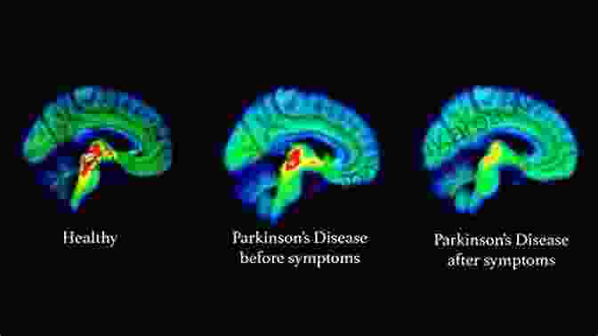 A PET Scan Of The Brain, Showing Areas Of Reduced Metabolic Activity In The Basal Ganglia, A Characteristic Feature Of Parkinson's Disease. Imaging In Movement DisFree Downloads: Imaging In Atypical Parkinsonism And Familial Movement DisFree Downloads (ISSN 142)