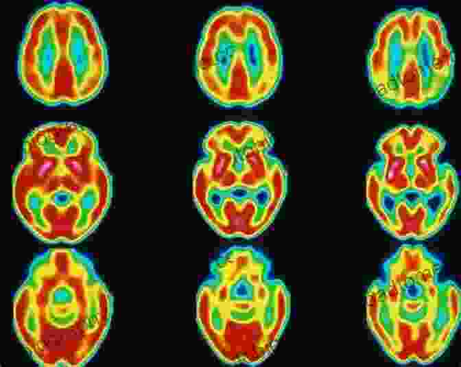 A SPECT Scan Of The Brain, Revealing Areas Of Reduced Blood Flow In The Putamen, A Region Associated With Dystonia. Imaging In Movement DisFree Downloads: Imaging In Atypical Parkinsonism And Familial Movement DisFree Downloads (ISSN 142)