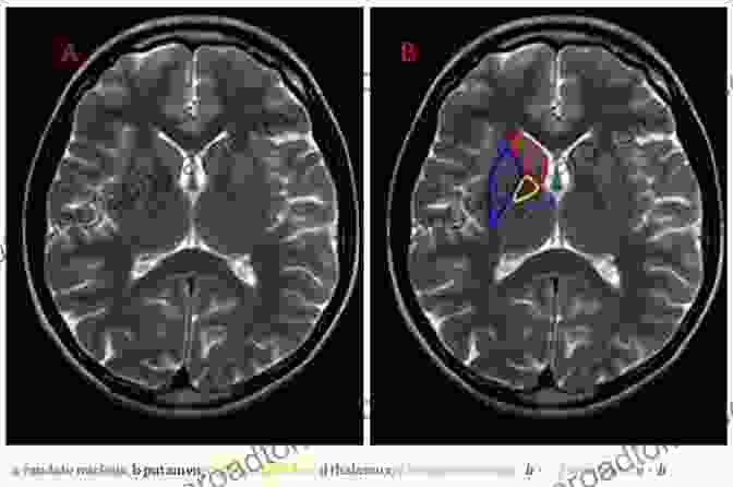 An MRI Scan Of The Brain, Highlighting The Basal Ganglia And Cerebellum, Which Are Key Brain Regions Involved In Motor Control. Imaging In Movement DisFree Downloads: Imaging In Atypical Parkinsonism And Familial Movement DisFree Downloads (ISSN 142)