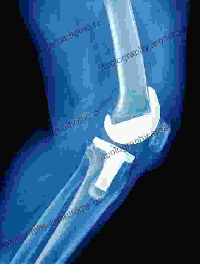 An X Ray Image Of An Artificial Knee Joint Medical Marvels: The 100 Greatest Advances In Medicine