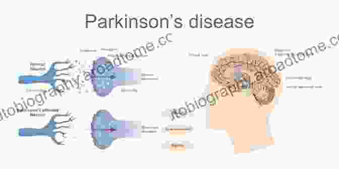 Diagram Of Parkinson's Disease Genes Parkinson S Disease (Genes Disease) Natalie Goldstein