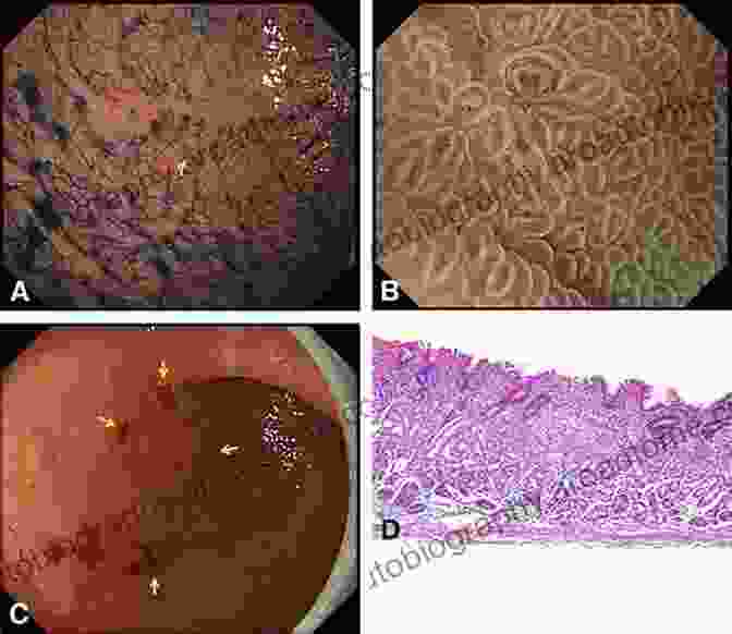 Endoscopic Image Of A Gastric Cancer Gastrointestinal Malignancies: New Innovative Diagnostics And Treatment