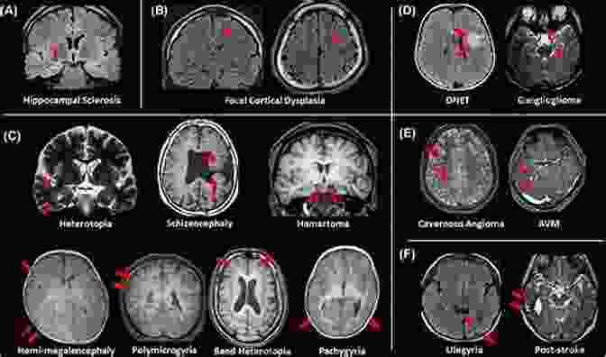 Image Of A Brain Scan Showing Epilepsy Related Abnormalities Epilepsy Unveiled: Caretaking Seizures Psychosis And Brain Surgery