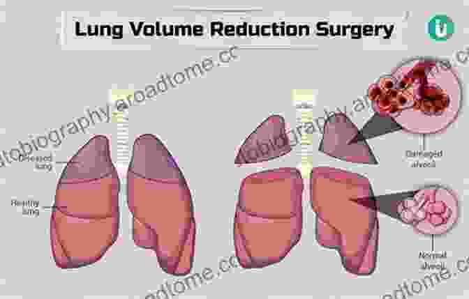 Image Of Lung Volume Reduction Surgery Procedure Lung Volume Reduction Surgery