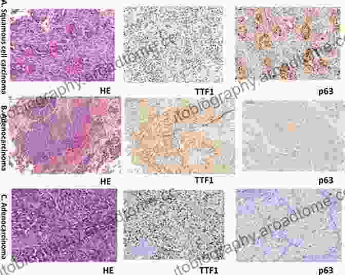 Immunohistochemistry In Tumor Diagnosis Application Of Monoclonal Antibodies In Tumor Pathology (Developments In Oncology 50)