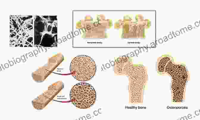 X Ray Image Showing Bone Density And Structure The Aging Skeleton Clifford J Rosen