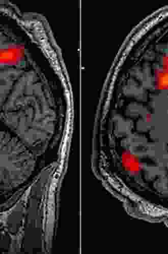 Imaging In Movement Disorders: Imaging In Atypical Parkinsonism And Familial Movement Disorders (ISSN 142)