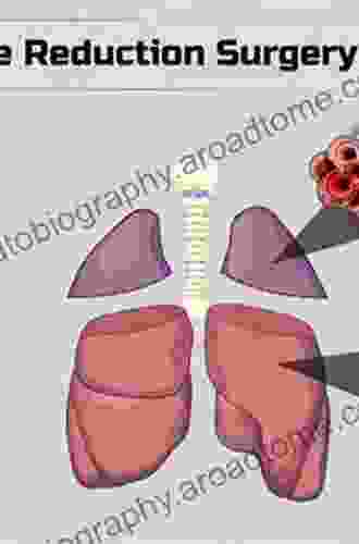 Lung Volume Reduction Surgery